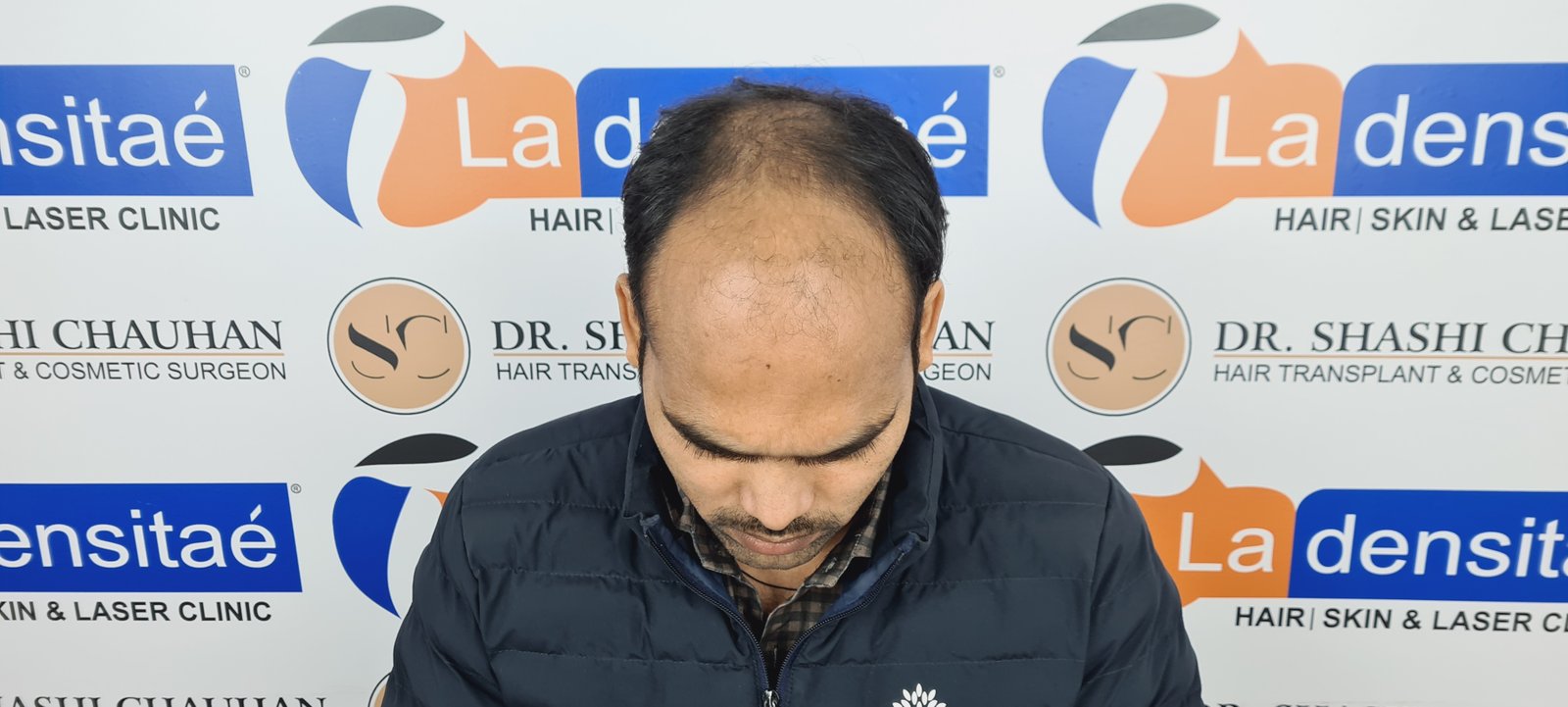 Anesh Kumar Before Hair Transplant